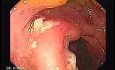 Colonic Tuberculosis Mimicking Crohn's Disease (4 of 12)