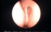 Successful endoscopic dacrocystorhinostomy - postoperative view