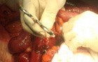 Mesenteric Ischemia (8 of 12)