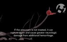 First Aneurysm Bleed