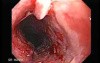 Esophageal Squamous Cell Carcinoma (1 of 2)