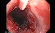 Esophageal Squamous Cell Carcinoma (1 of 2)