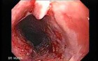 Esophageal Squamous Cell Carcinoma (1 of 2)