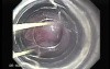 Severe Bleeding of the Upper Digestive System After Two Days of Band Ligation - A Case of 57 Years-Old Alcoholic Male