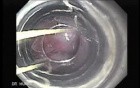 Severe Bleeding of the Upper Digestive System After Two Days of Band Ligation - A Case of 57 Years-Old Alcoholic Male