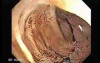 Radiation Enteritis (2 of 4)