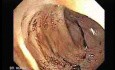 Radiation Enteritis (2 of 4)