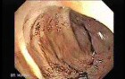 Radiation Enteritis (2 of 4)