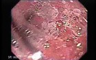 Barrett's Esophagus of long segment (5 of 24)