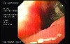 Flexible Endoscopic Suturing - Preparing the Sutures