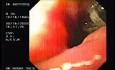 Flexible Endoscopic Suturing - Preparing the Sutures