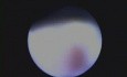 Micro Ultrasonic Periodontal Pocket Cleaning