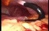 Gastrointestinal Stromal Tumor - GIST (35 of 65)