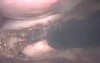 Total Laparoscopic Hysterectomy