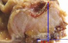 Adenocarcinoma of the Antrum and incisura angularis (6 of 12)