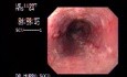 Severe Esophagitis - Erosions With Whitish Exudate