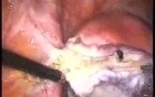 Laparoscopic Bilateral Genital Adnexectomy