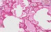 Lung - Acute Pulmonary Edema - Asbestos Bodies