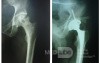 Total Hip Arthroplasty