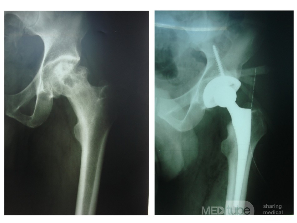 Total Hip Arthroplasty