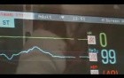 Awake Mitral Valve Replacement -  Chordee Preservation EP Mode