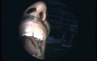 Erosive Buccal Lichen Planus