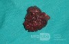 Giant Multilobulated Gastric Polyp (17 of 20)