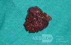 Giant Multilobulated Gastric Polyp (17 of 20)