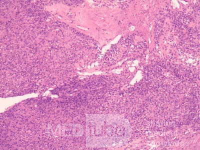 Gastrointestinal Stromal tumor (GIST) (55 of 65)