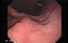 Gastric Cancer - Intestinal Metaplasia - Endoscopy (3 of 7)