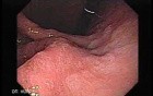 Gastric Cancer - Intestinal Metaplasia - Endoscopy (3 of 7)
