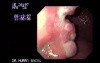 Ulcerative Carcinoma of the Gastric Body - Endoscopy 1