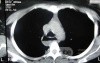 Esophagus - Pneumatic Dilation for Achalasia (29 of 31)