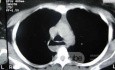 Esophagus - Pneumatic Dilation for Achalasia (29 of 31)