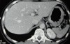 Endoscopy of Scirrhous Gastric Carcinoma involving the entire Fundus, Body and the Antrum (18 of 47)