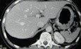 Endoscopy of Scirrhous Gastric Carcinoma involving the entire Fundus, Body and the Antrum (18 of 47)