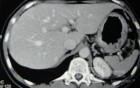 Endoscopy of Scirrhous Gastric Carcinoma involving the entire Fundus, Body and the Antrum (18 of 47)