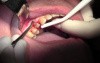 Flap Reflection & Pouch - Extraction #5 with Socket Bone Grafting - d-PTFE