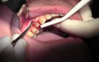 Flap Reflection & Pouch - Extraction #5 with Socket Bone Grafting - d-PTFE