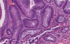Tubular adenoma (adenomatous polyp) - Histopathology - Colon