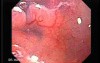 Adenocarcinoma of the Lesser Curvature with Signet Ring Cells (8 of 8)