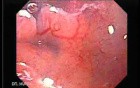 Adenocarcinoma of the Lesser Curvature with Signet Ring Cells (8 of 8)