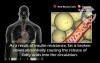 Diabetes: Type 2