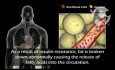 Diabetes: Type 2
