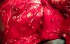 The Nape Of Neck Flap