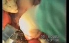 Esophageal Cancer Surgery- Esophagogastrectomy With Lymphadenectomy