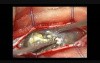  Spinal Intra Dural Epidermoid - Microsurgical Removal