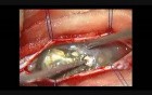  Spinal Intra Dural Epidermoid - Microsurgical Removal