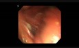 ESD For Gastric SMT