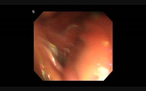ESD For Gastric SMT